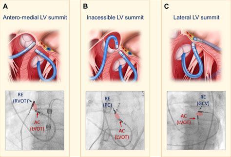 lv summit pvc morphology|cardiac ablation pvc news today.